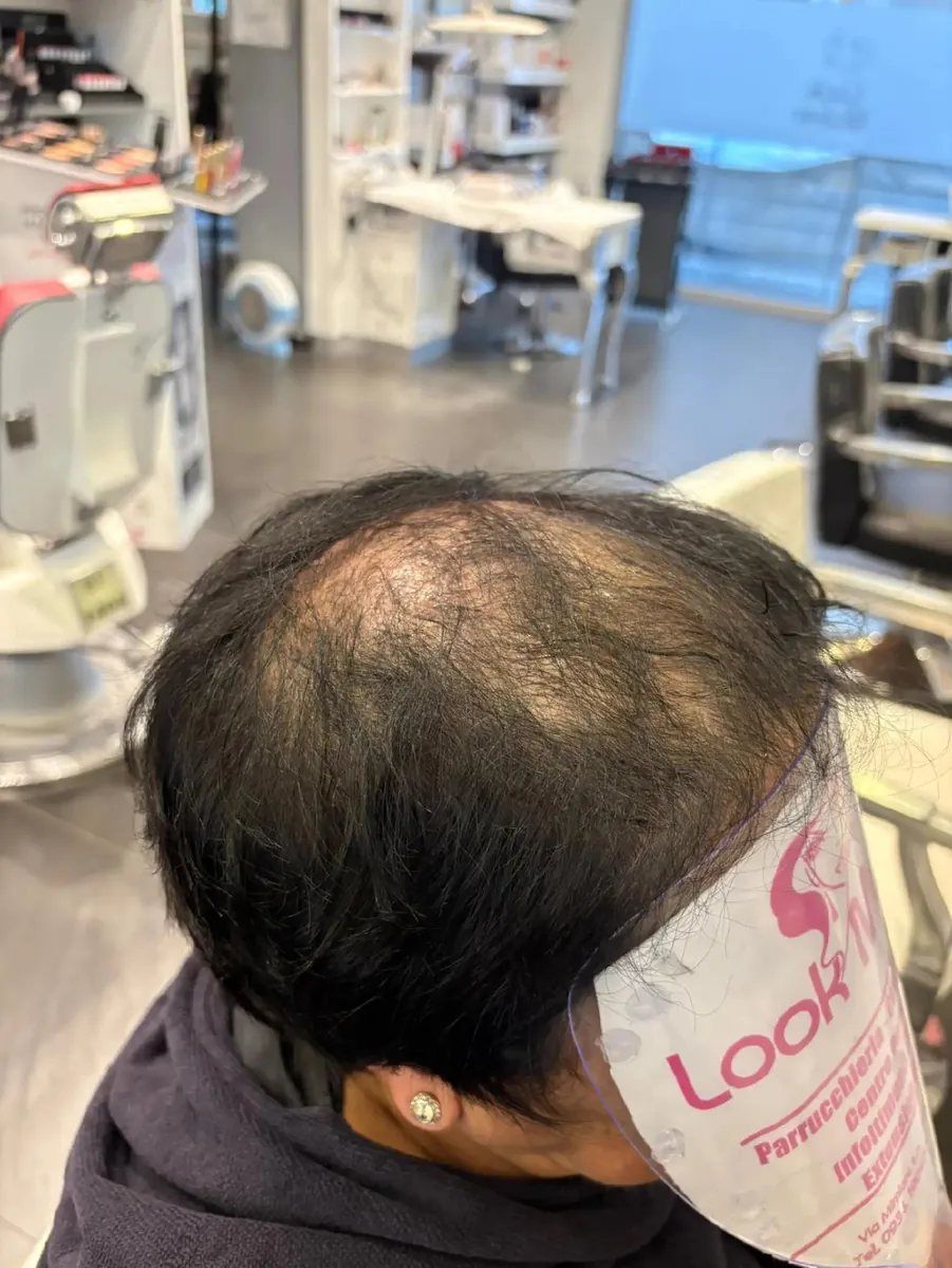 Prima dell'infoltimento: capelli radi sulla sommità