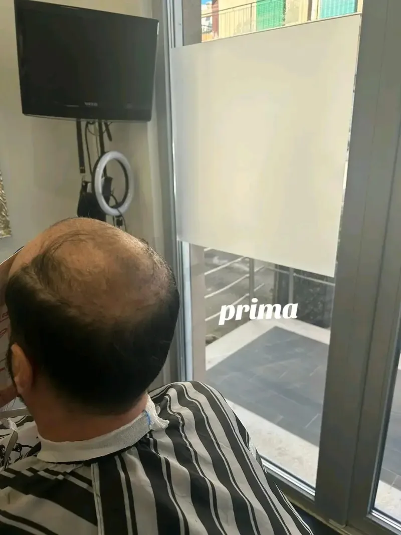 Prima: sommità calva di un uomo, vista da dietro