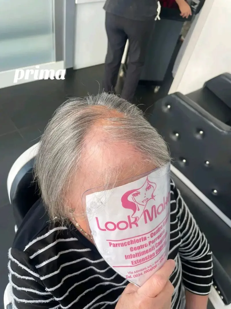 Prima: capelli grigi radi sulla fronte